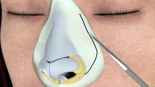 Piezo  Ultrasonik  Burun Estetiği 3D Animasyon  Dr Baris Yigit [upl. by Hogle]