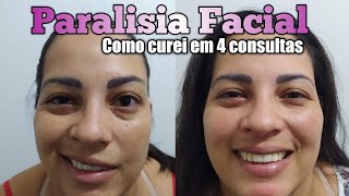 PARALISIA FACIAL CURA EM 4 SESSÕES  DR ROMULO PIMENTA [upl. by Emarej]