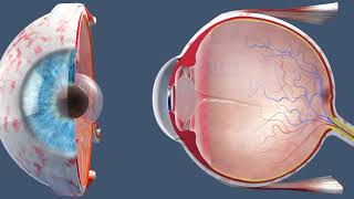 What is a YAG Laser Capsulotomy [upl. by Elocin]