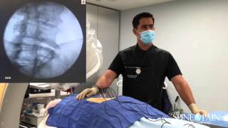 Radiofrequency Ablation Procedure [upl. by Friedrick]