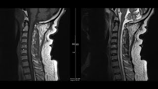 Noncontrast MRI cervical spine search pattern [upl. by Kolodgie]