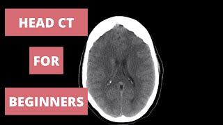 How to Read a Head CT  Radiology Approach [upl. by Aicined971]