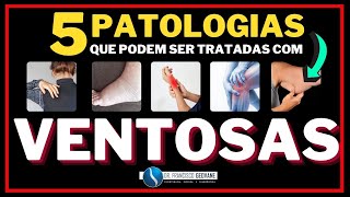 VENTOSATERAPIA  05 PATOLOGIAS que podem ser Tratadas com VENTOSAS [upl. by Meehaf883]