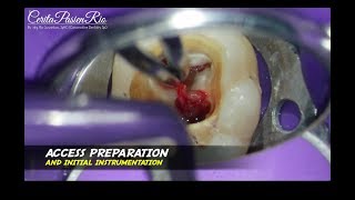 one visit endodontic treatment wisdom tooth perawatan saluran akar 1 kali kunjungan [upl. by Aryahay]