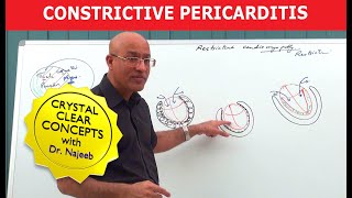 Myocardial Infarction Heart Attack for Nursing amp NCLEX [upl. by Anhavas]