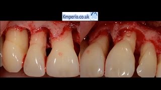 Periodontal Surgery with Regeneration for Upper Teeth [upl. by Aztinaj]