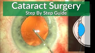 Cataract Surgery Teaching  A Beginners Guide [upl. by Chuah]