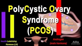 Polycystic Ovary Syndrome PCOS Pathology and Treatment Animation [upl. by Yhtur265]