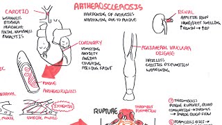 Atherosclerosis  Pathophysiology [upl. by Stuart874]