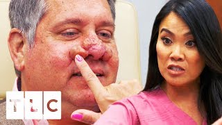 Treating A SEVERE Case Of Rhinophyma  Dr Pimple Popper [upl. by Ayiram]