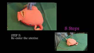 How to perform BLynch Suture [upl. by Dolph]