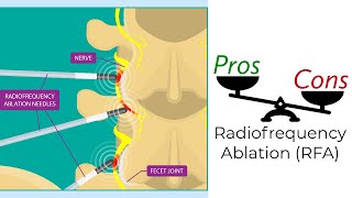 Radiofrequency Ablation  Pros amp Cons [upl. by Arinaid]