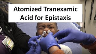 Atomized Tranexamic Acid for Epistaxis Control [upl. by Atiner]