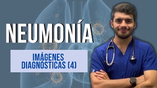 NEUMONÍA  Imágenes diagnósticas Parte 4 [upl. by Epul]