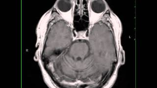 Paraneoplastic Cerebellar Atrophy [upl. by Gnilsia]