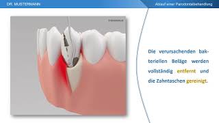 Ablauf der Behandlung  Parodontalbehandlung [upl. by Anoyet]