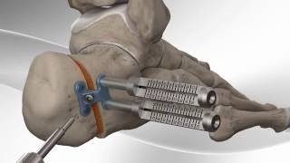 Flatfoot Repair with Arthrex® Calcaneus Step Plate [upl. by Darcie120]