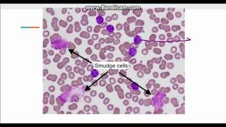 Chronic Lymphocytic Leukemia CLL [upl. by Lachus]