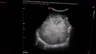 Neuroblastoma Sonography [upl. by Tinya274]