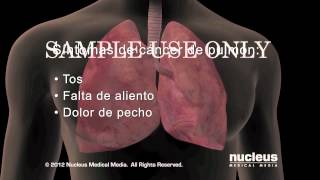 Síntomas del cáncer de pulmón [upl. by Nadabas547]